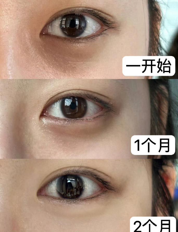 Dark Circle Reducing Essential Oil